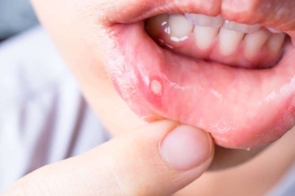7 طرق فعالة لعلاج القرحات القلاعية نهائيا (دليل 2025)