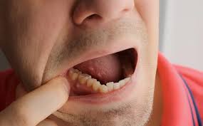 الفرق بين خراج اللثة وخراج الأسنان: 5 فروقات أساسية للعلاج الصحيح والفعال