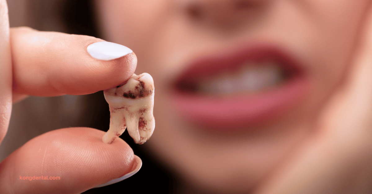 5 أنواع من تسوس الأسنان يجب أن تعرفها وطرق علاجها الفعالة